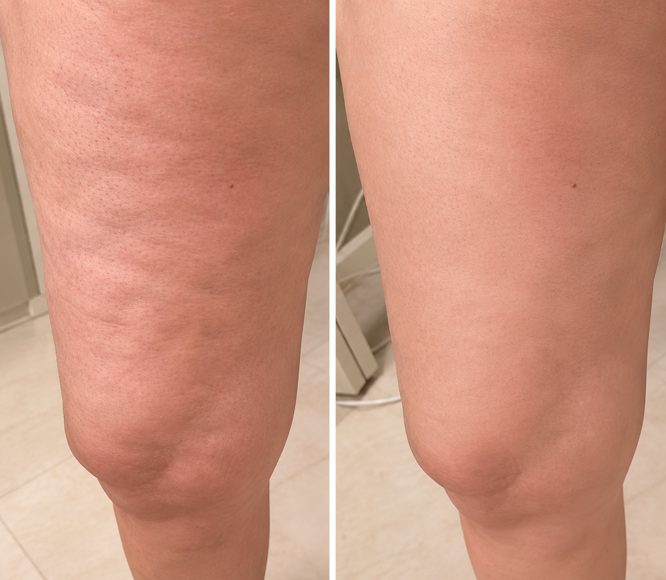 Straffendes Anti-Cellulite Massageöl